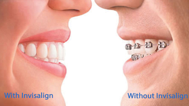 Invisalign in Midtown East