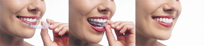 Sutton Hill Clear Braces